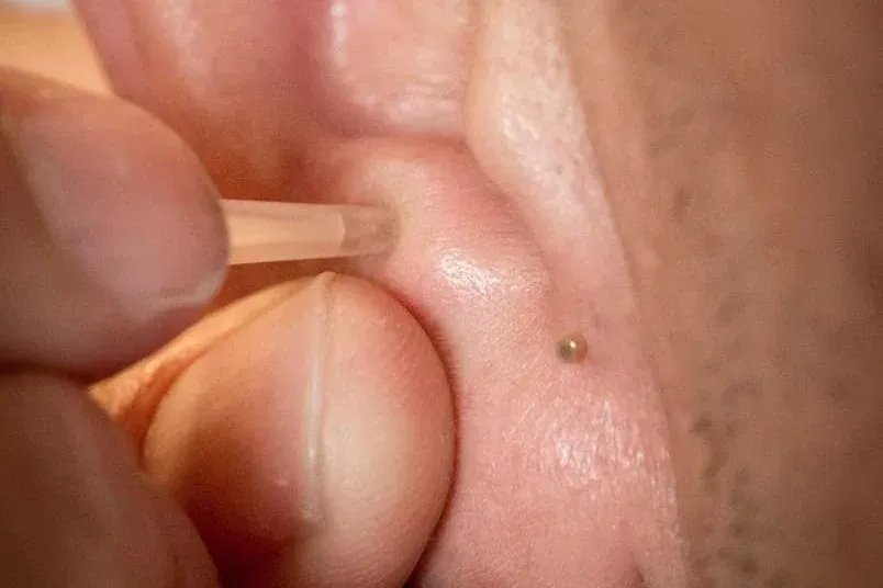 closeup of patient receiving bfa treatment in ear