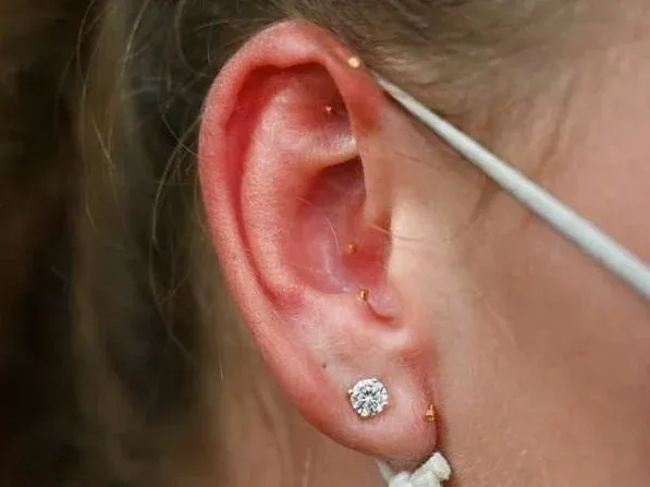 example of five bfa needles in a woman's ear