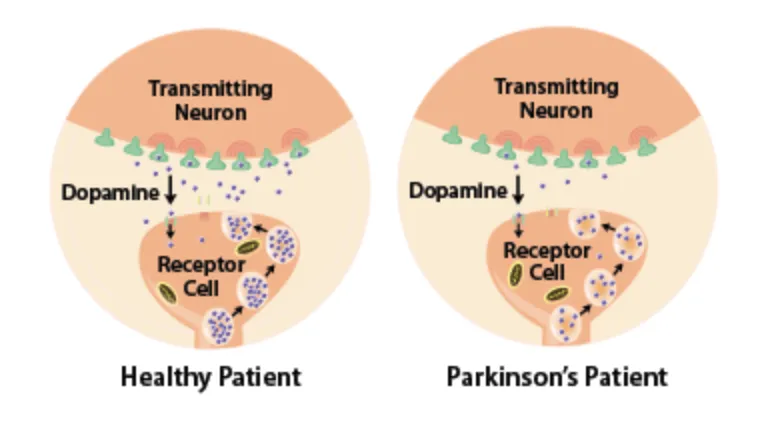 Diagram of how Parkinson's Disease Affects People's Neurons